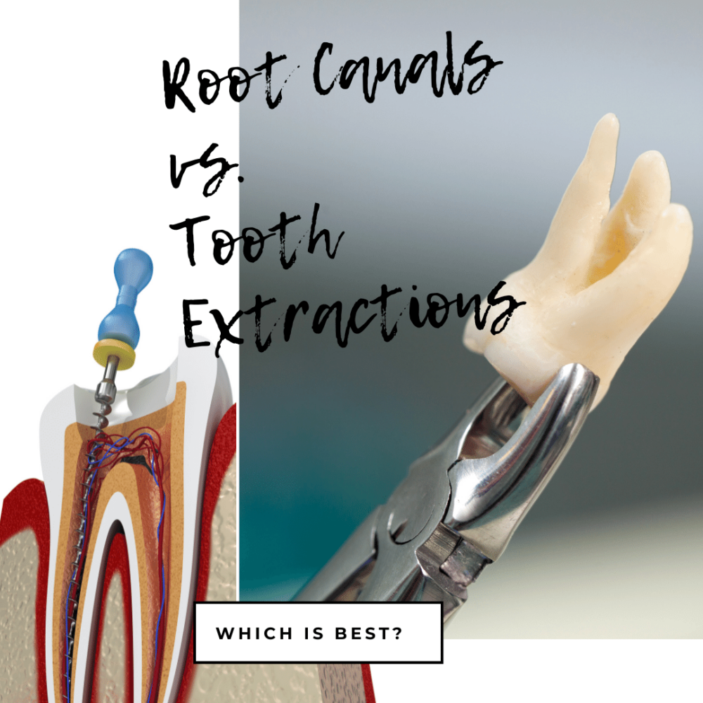 Root Canals vs. Tooth Extractions: Which is Best?