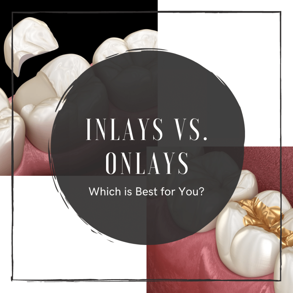 Inlays vs. Onlays: Which is Best for You?