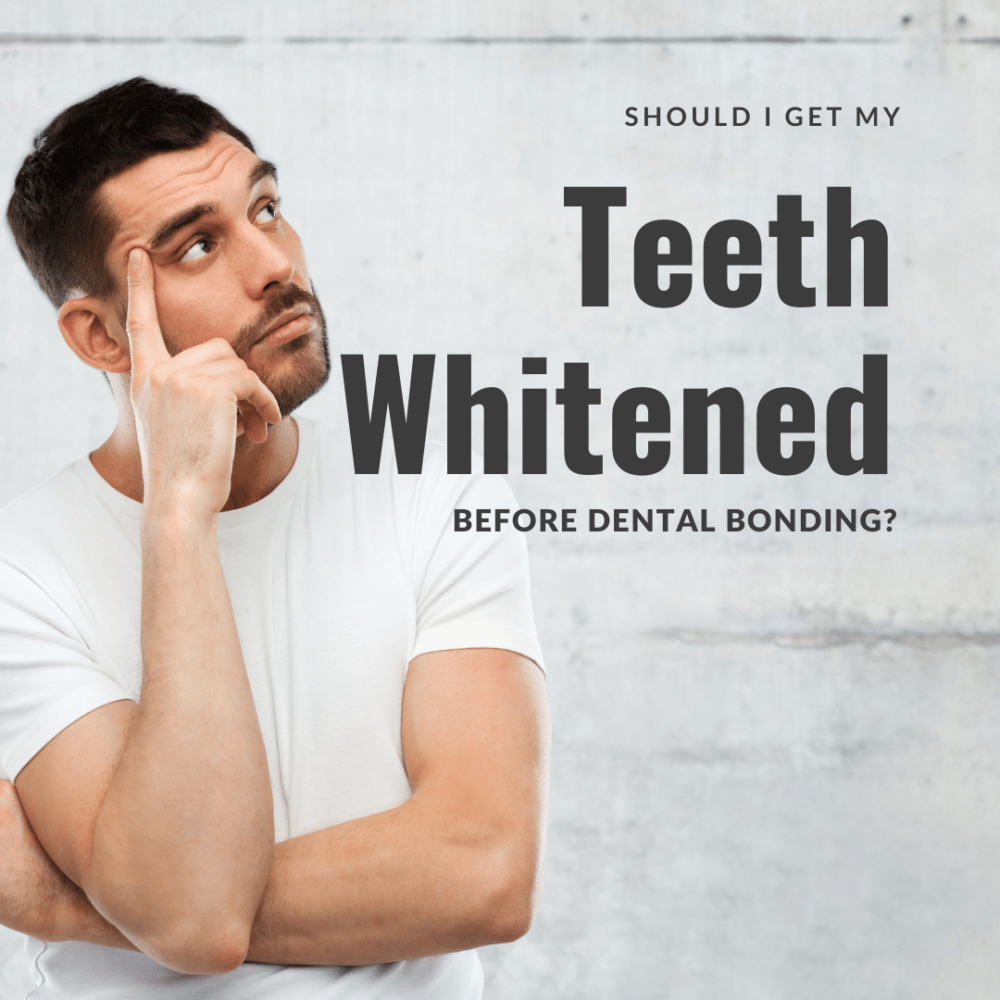 Should I Get my Teeth Whitened Before Dental Bonding?
